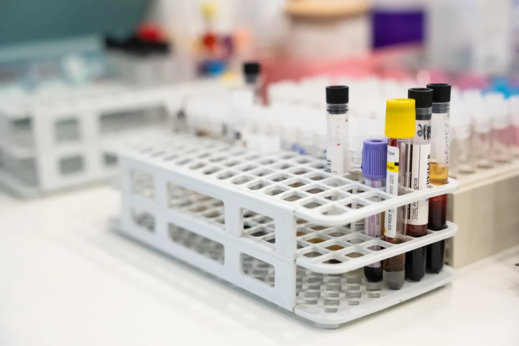 Δείγματα αίματος σε δοκιμαστικούς σωλήνες στο εργαστήριο